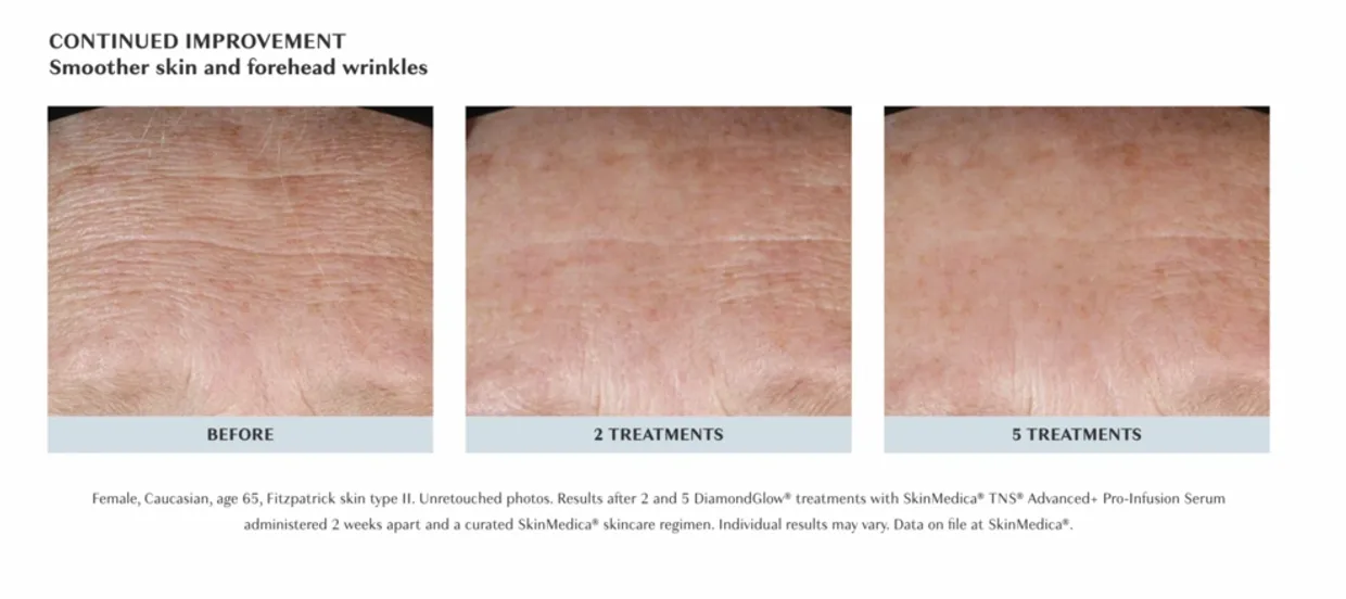 Microneedling before and after results showing smoother forehead wrinkles